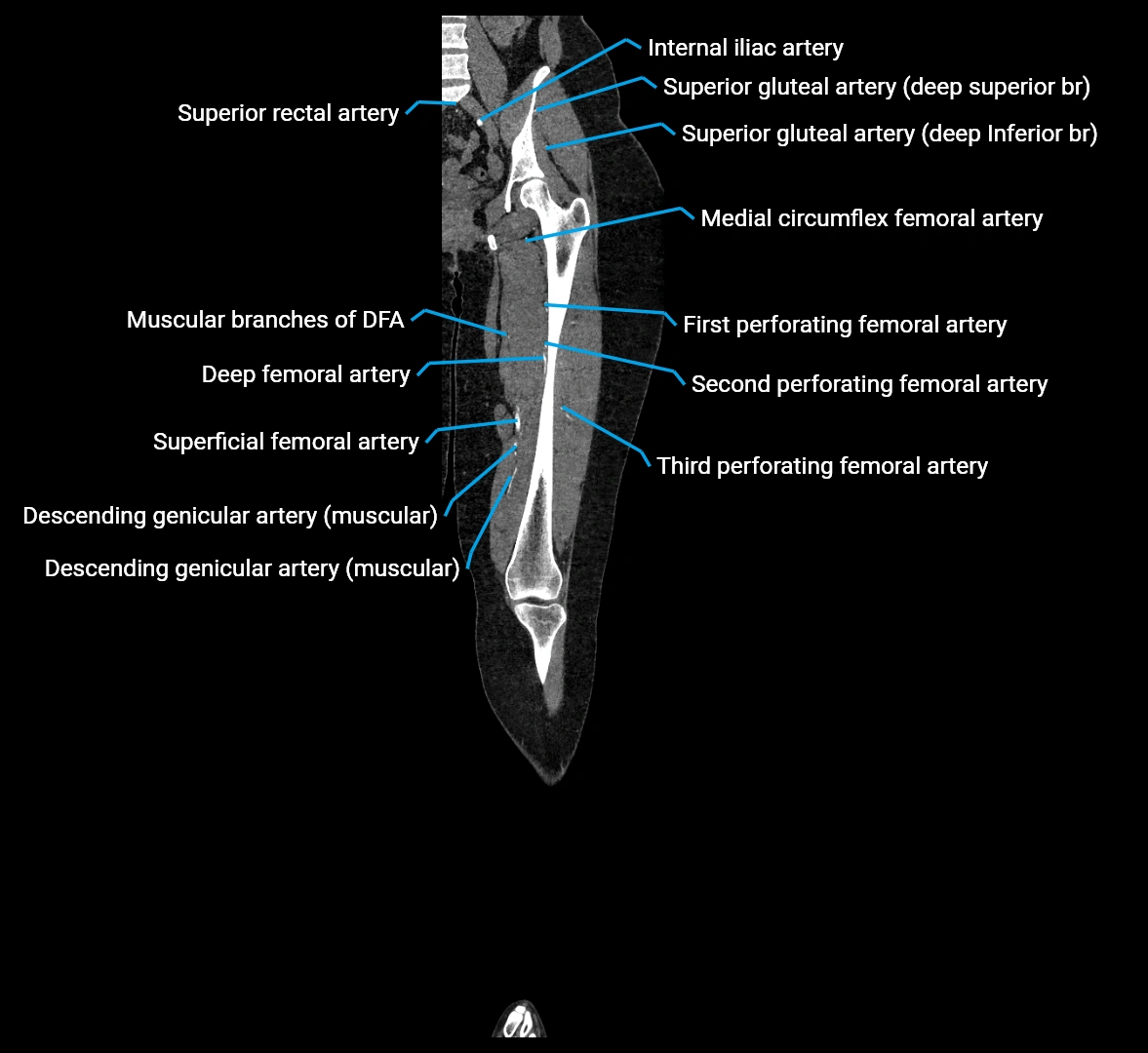 CTA lower limb coronal cross sectional anatomy labelled image _40 (2).webp